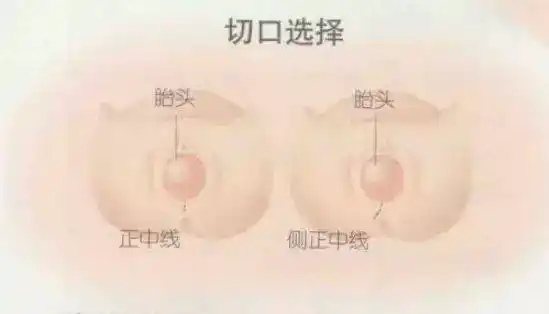 生孩子你被侧切了吗?其实你可以不挨这一刀