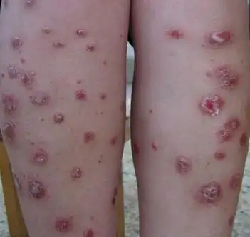 100种皮肤病图片对照图_银屑病求医网