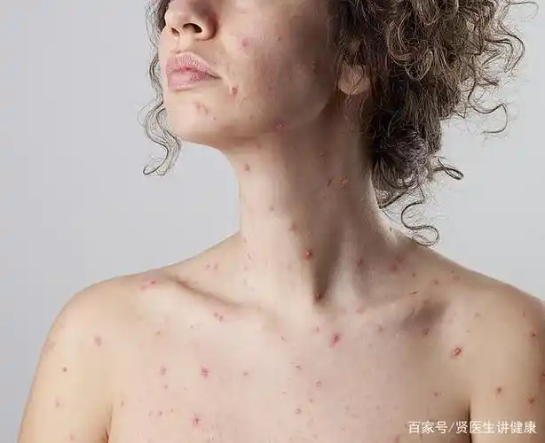 单纯疱疹病毒感染,常发病在皮肤表面,有传染性,有症状便就医 - 坏妈妈