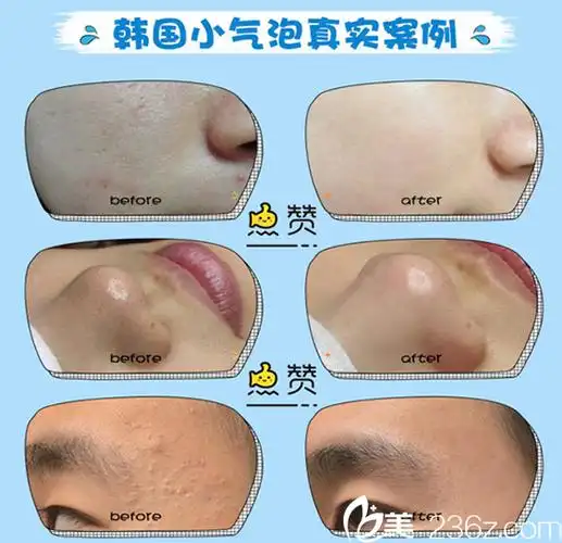 在蚌埠华美整形美容医院孙佳佳做过的韩国小气泡真实案例前后效果对比