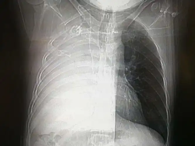 入院后的影像学检查发现这个病人的右肺已全肺不张