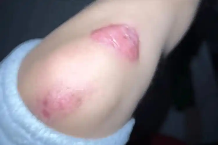 疤痕增生终于解决了!