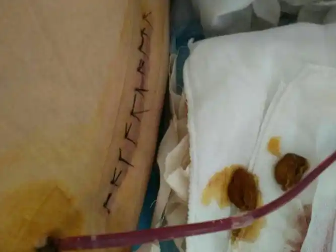 背部脊椎手术后