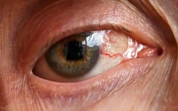 干眼症最常见的症状(干眼症的具体症状)_美食相关信息_大遂网