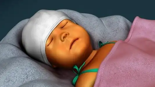 刚出生的婴儿黄疸照片