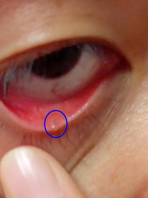 很长时间了,因为没有什么不适就忽略了,但是这几天发现有点长大了.