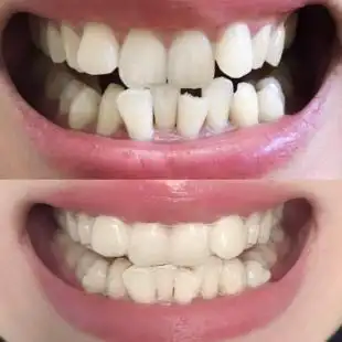 牙齿矫正器隐形透明牙套整牙神器成人磨龅牙保持器夜间地包天纠正,可