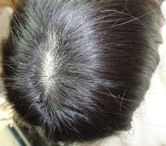 这情况属于什么类型的脱发?怎样治疗?用生姜擦头皮可以吗?