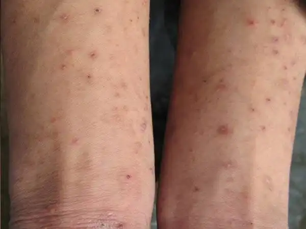 大腿上长疥疮能够治好吗?需要多少钱才能治好呢?