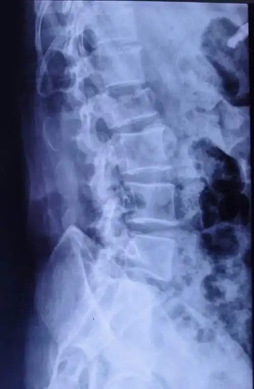 腰2椎体压缩性骨折,闭合复位微创经皮钉棒系统内固定手术治疗.