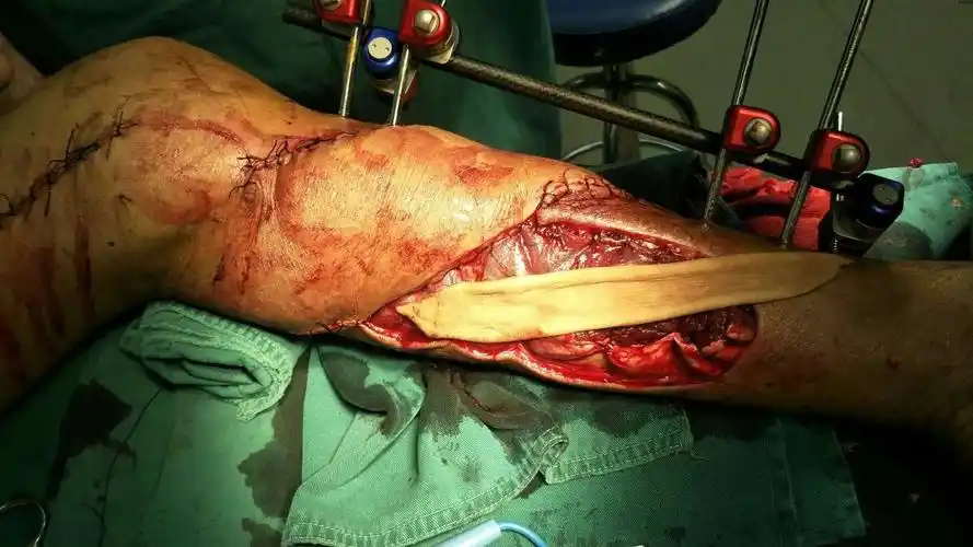 兴国第二医院外二科成功为一患者行左小腿内侧腓肠肌皮瓣转移术