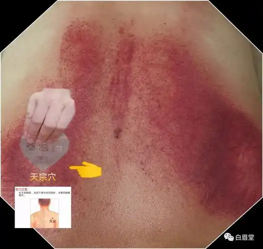 "乳腺增生"宜行(刮)痧