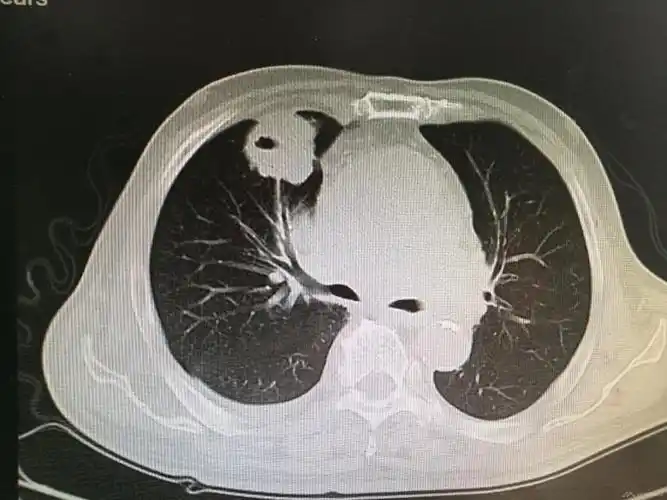 晚期肺癌1例-医联