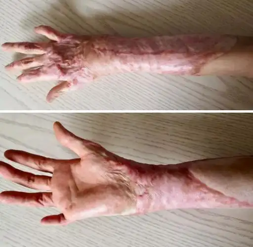 烧伤好了后很痒怎么办 烧伤好了后痒痒是怎么回事