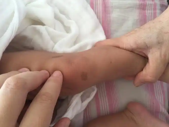 咖啡斑和神经纤维瘤病