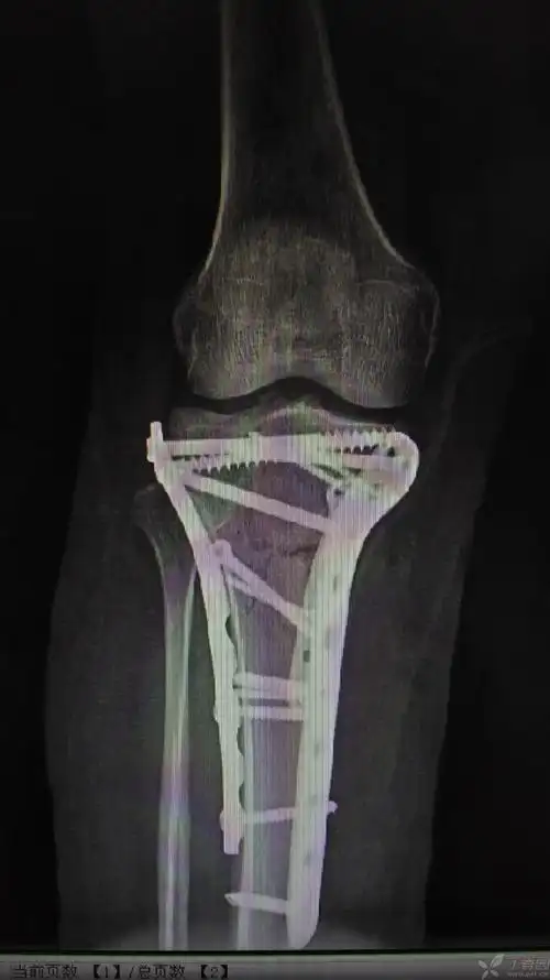 Ⅵ型胫骨平台骨折一例,请指教!