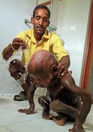 全世界不到10例,11岁男孩患罕见怪病,没钱医治将变"石头人" - 360娱乐