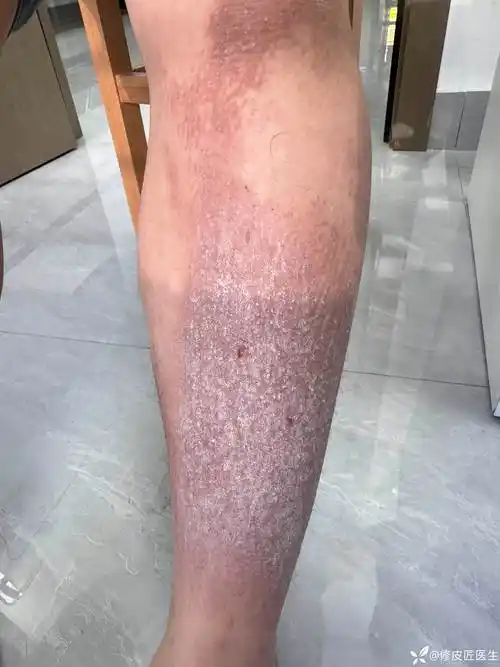 双下肢皮疹,瘙痒剧烈,是什么问题?