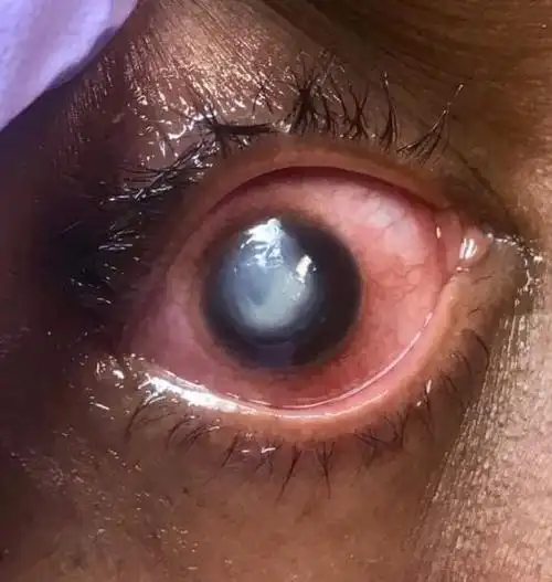 惨戴隐形眼镜睡觉眼球变白还流出萤光眼泪