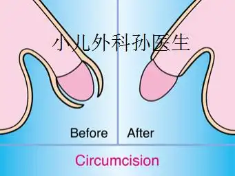 dr.sun|小男孩包皮,究竟要不要切?-孙俊杰主任医师-爱问医生