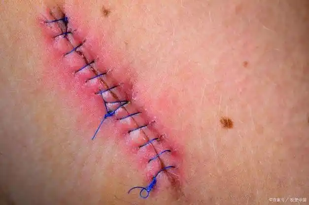 红色疤痕怎么变回肉色红色疤痕变回肉色的方法与策略