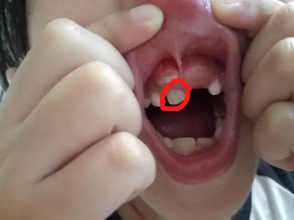 一直到现在这颗门牙都没掉,可是门牙上面从牙龈又长了一颗出来怎么办?