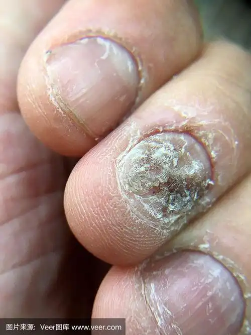 指甲真菌感染的大特写手,指甲真菌病的手指,指甲真菌感染.