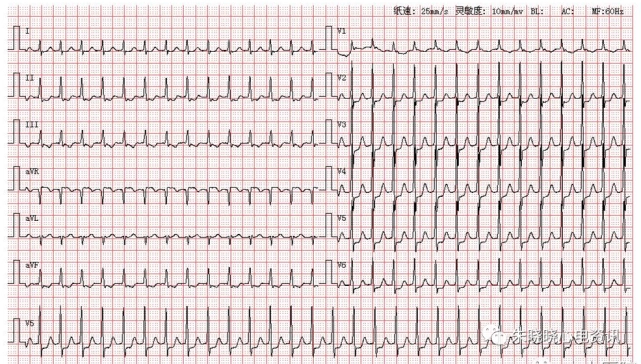 每日读图|第1367期 阵发性室上性心动过速|室上性心动过速|心电图