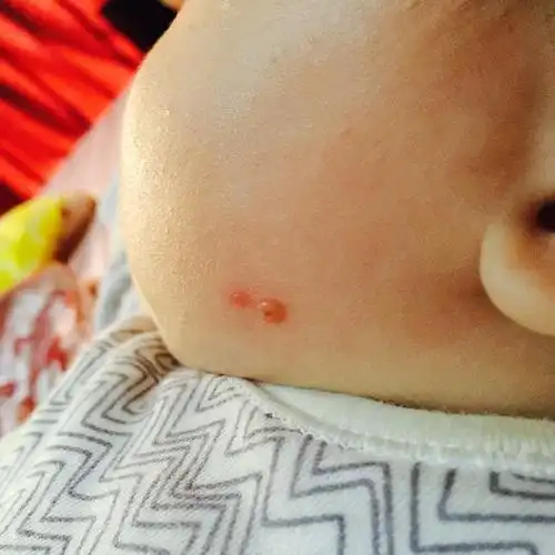 宝宝脸上长了一颗这个肉疙瘩怎么办