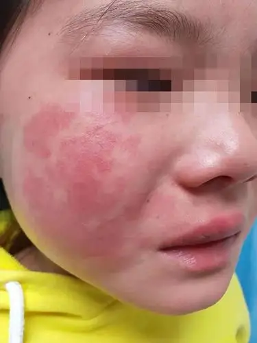 鲜红斑痣治疗前