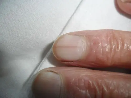 甲母痣请大家讨论此病一周良版11月25日