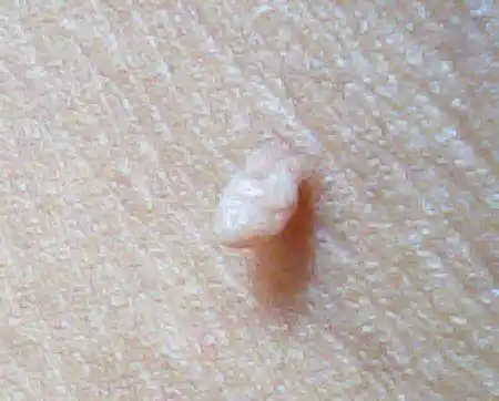 这些小肉球的名字叫做皮肤赘生物,也叫做纤维瘤.