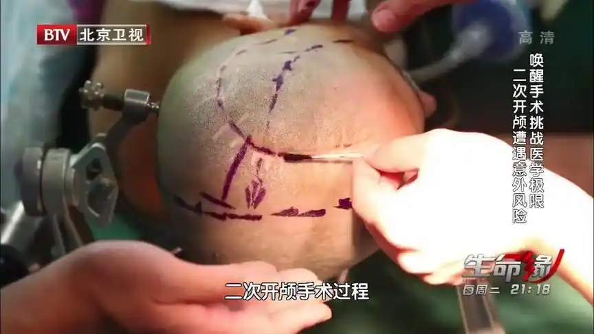 医生进行二次开颅手术,病人脑中的粘连情况,比预想的还要严重