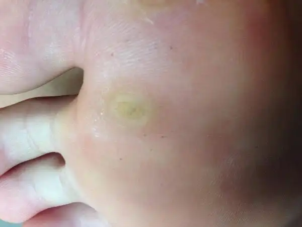 脚底长了个东西,走起路来很痛,碰着去也痛,请问这是什么,要怎么解决它