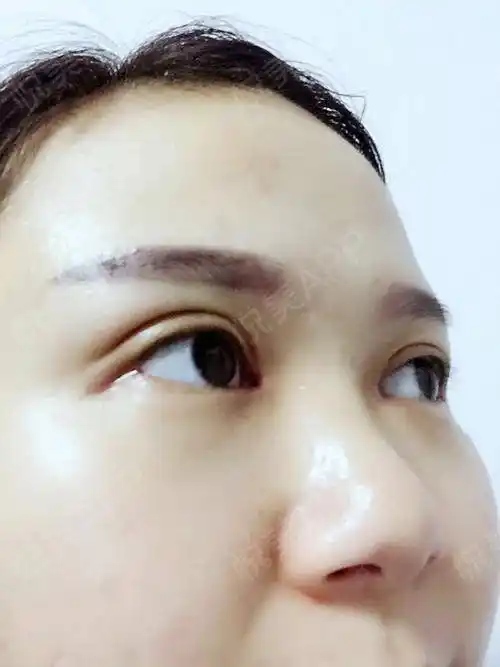 全切双眼皮术后15天_开眼角术后15天_双眼皮术后15天_眼部整形术后15