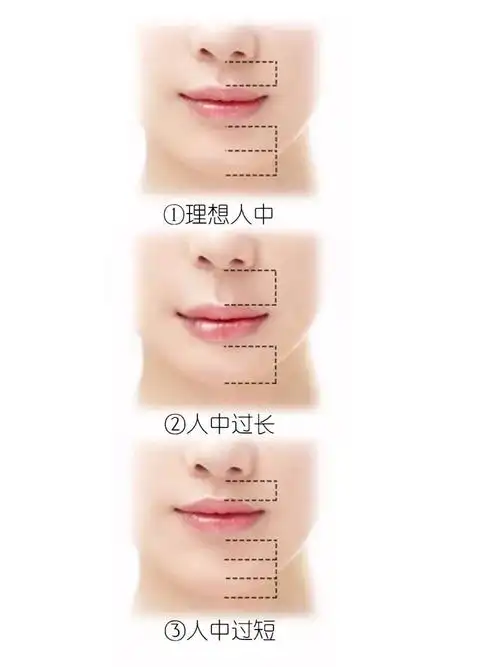 人中太长,到底要不要做缩短手术呢?