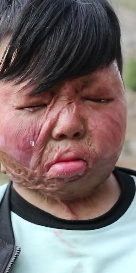 上山干活被大火烧伤,妈妈次日便提出和爸爸离婚