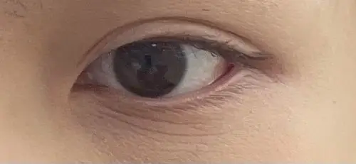 眼下细纹如六十岁老人