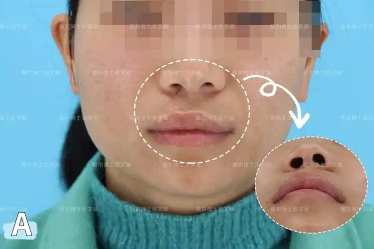 案例分析1岁做了唇裂修复术后出现了唇部畸形34岁终于做手术修复了