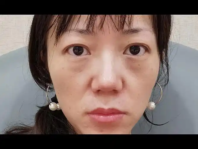 诊断:求美者面部肌肉松弛下垂,法令纹凹陷严重,皮肤暗沉无光泽,苹果肌