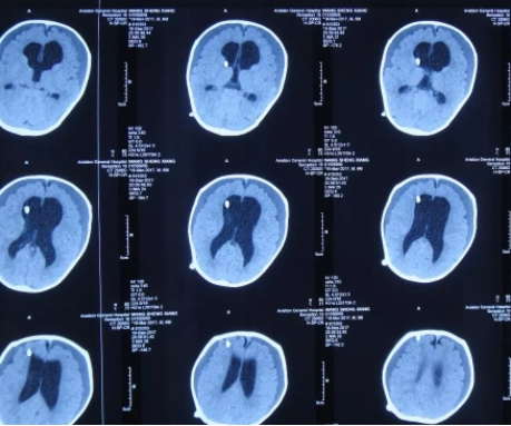 3个月宝宝婴儿脑积水嗜睡哭闹,呕吐落日征,外院omaya囊置入术后颅内