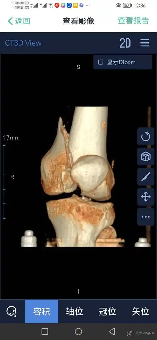 股骨髁间粉碎性骨折