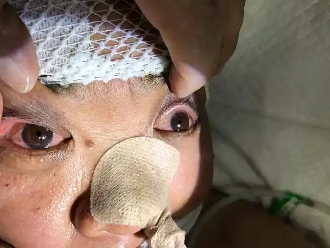 病人脑干出血术后,瞳孔等大,1.5毫米