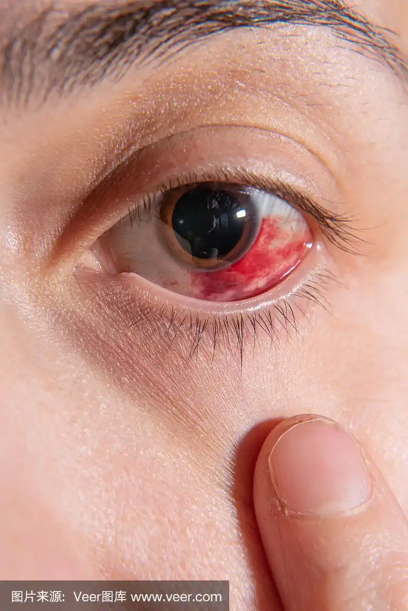 一个女孩眼睛出血.角膜的磨损.宏.