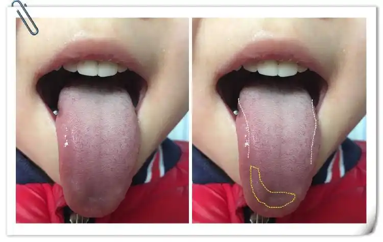 【第149期】寒吐的舌象