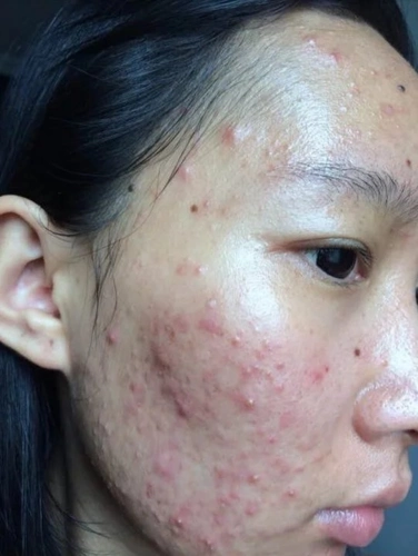 快速告别痘痘肌!护肤老师胡兰芝告诉你哦