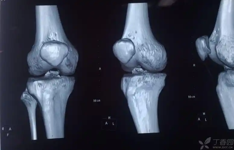 胫骨髁间棘骨折