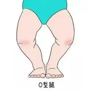 小家科普宝宝o型腿和穿纸尿裤无关