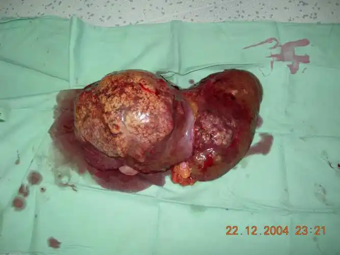 原发性肝癌病人的护理讲述