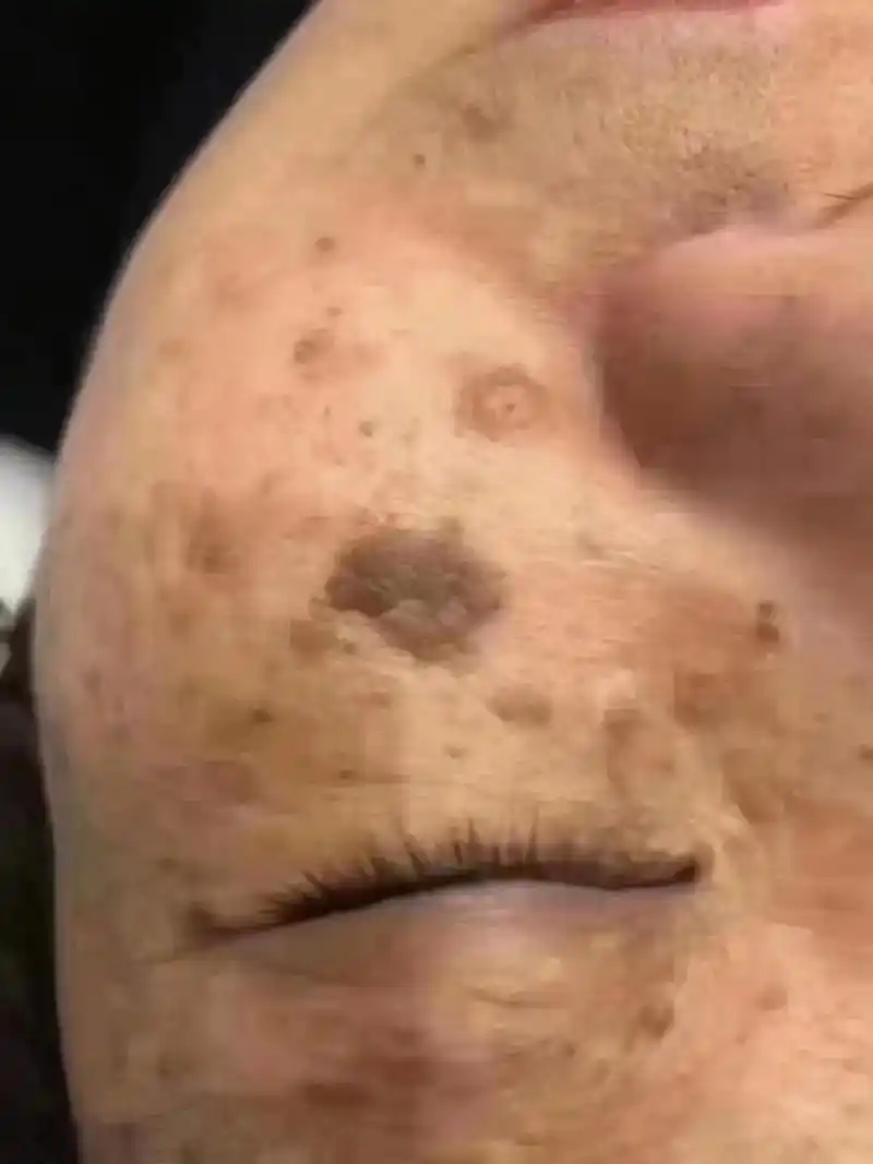 扁平疣,起初是肤色的凸起颗粒,很多人难以辨别,喜欢拿手扣越扣越大